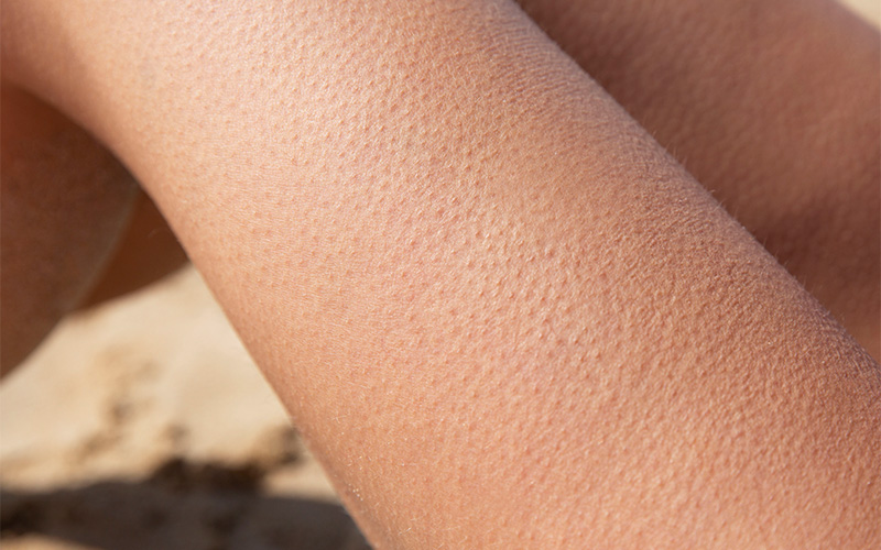 Close-up of human skin with visible goosebumps in natural sunlight